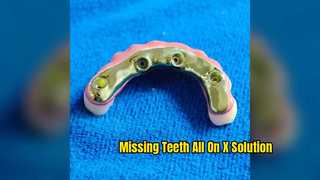 China Dental Lab All-On-X Restorations