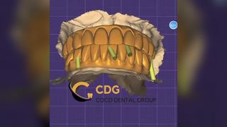 Zirconia Implant Restorations Stronger Dentures
